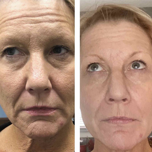 Skin Rejuvenation MAIN